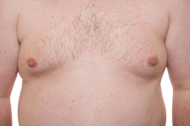 Man Boobs (Gynecomastia)